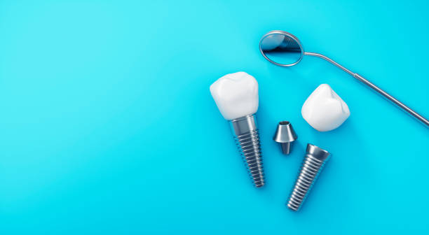 implantes-dentales-mitos-y-realidades-que-debes-conocer 2